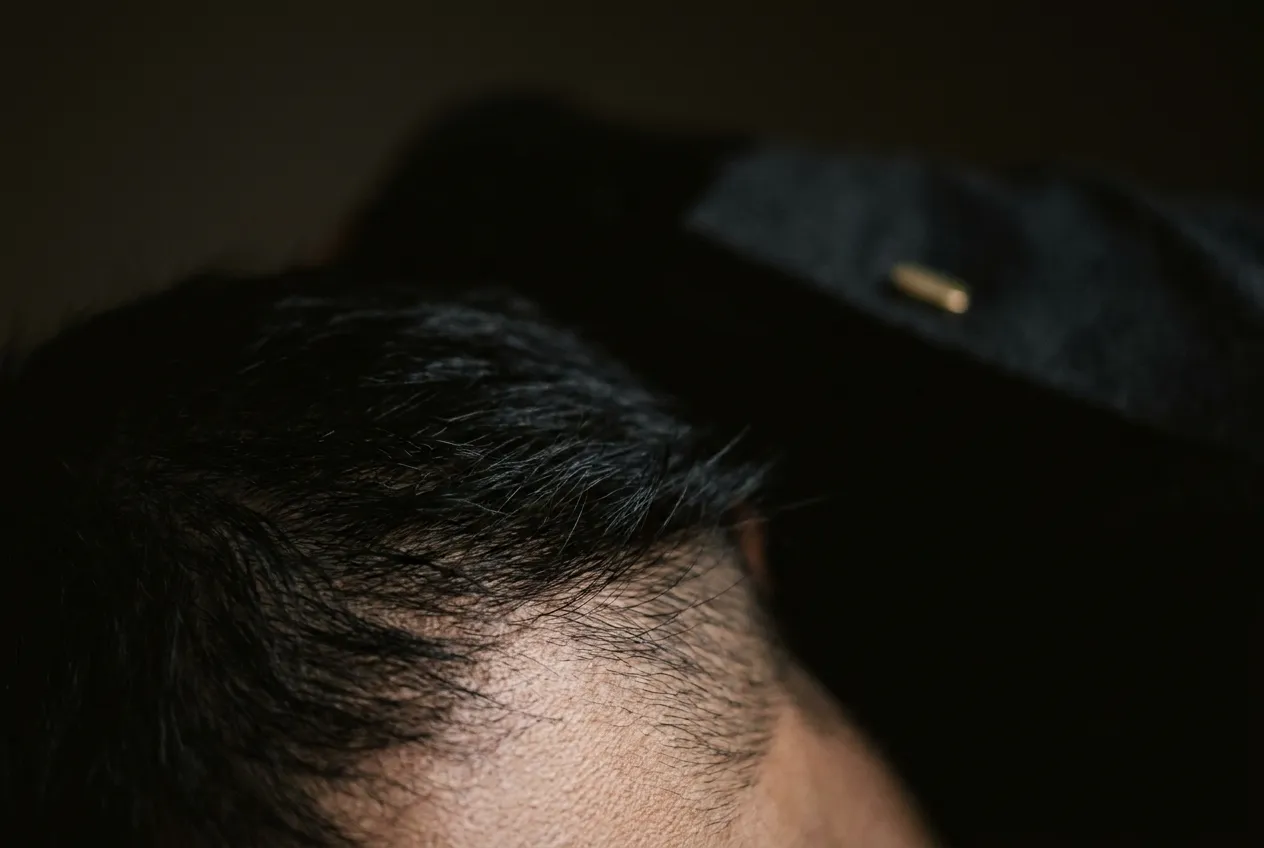 Detalle macro de la línea de nacimiento del pelo de un hombre, la zona que se diseña en un injerto capilar